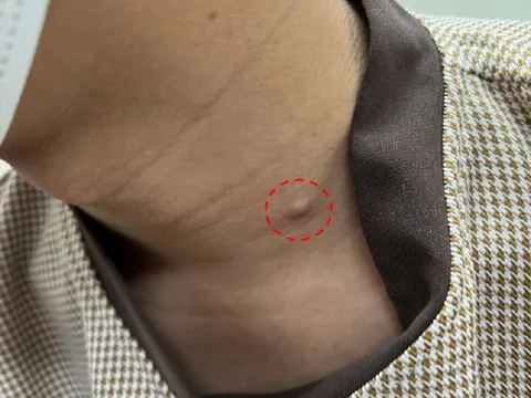 Mụn lâu lành biến thành ung thư