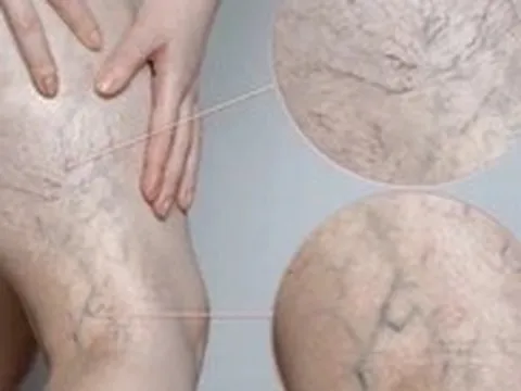 Chân đau nhức, mạch máu lộ rõ cảnh báo bệnh lý đang đe dọa 1/3 người trưởng thành