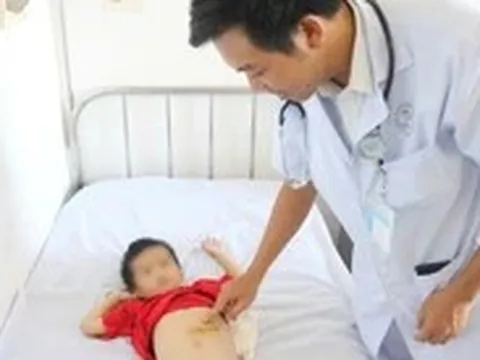 Phẫu thuật lấy búi tóc nặng nửa ký khỏi dạ dày bệnh nhi 5 tuổi