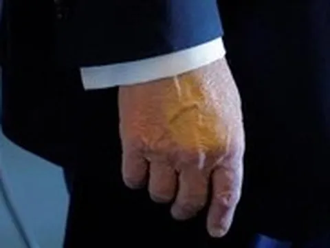 Bệnh suy tĩnh mạch mạn tính là bệnh gì, phòng tránh ra sao?