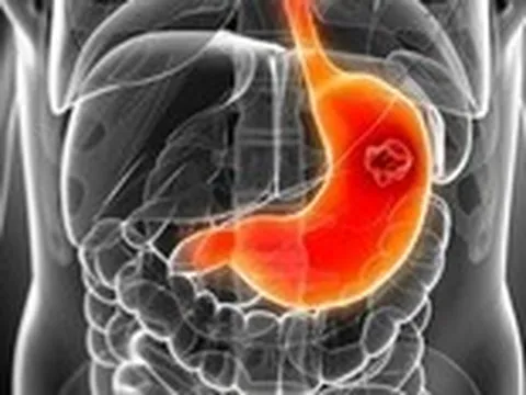 Cách trị viêm loét dạ dày - tá tràng qua bữa ăn