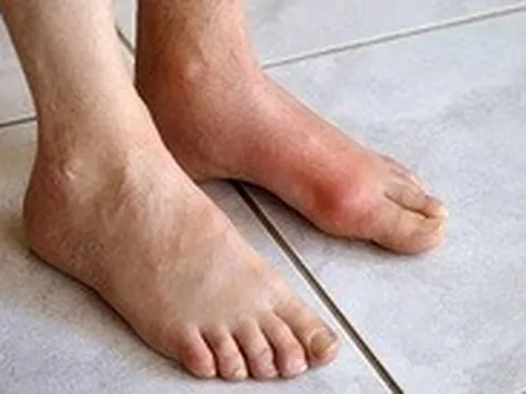 Chàng trai trẻ mắc bệnh gout ở tuổi 22, dấu hiệu cảnh báo từ đau khớp cổ chân
