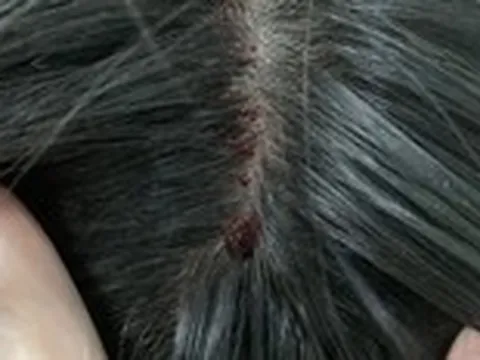 Chích máu đỉnh đầu, dái tai để chữa đột quỵ?