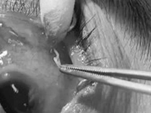 Phẫu thuật gắp con giun đũa dài 4cm trong mắt bệnh nhân