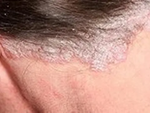 Bệnh vảy nến có thể trị khỏi được không?