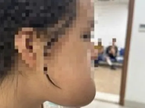 9 giờ liền phẫu thuật miễn phí cho thiếu nữ bị khối u khủng trên mặt