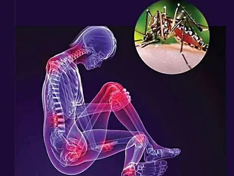 Dịch Chikungunya lan rộng liệu có nguy hiểm?