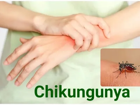 Bệnh Chikungunya đang diễn biến phức tạp, ai cần cẩn trọng?
