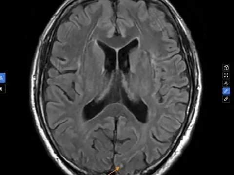Nhìn mờ thoáng qua rồi tự hết cũng có thể là dấu hiệu đột quỵ nguy hiểm, vì sao?