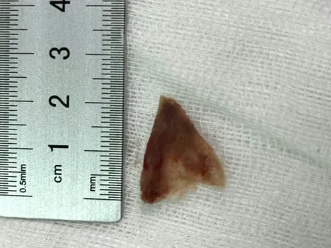 Mắc xương ngại đi bệnh viện, người phụ nữ dùng cách 'vuốt ngược'