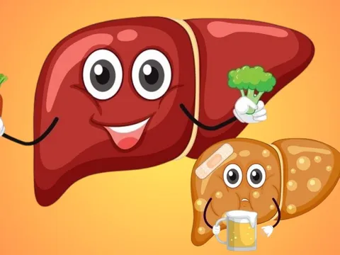 Không uống rượu bia vẫn bị gan nhiễm mỡ, ăn gì để ‘gan khỏe’?