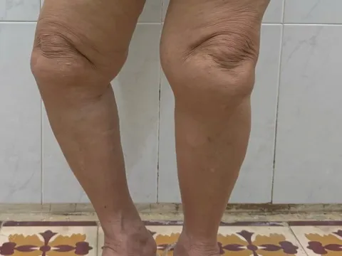 Lấy lại dáng đi cho người phụ nữ 69 tuổi nhờ kỹ thuật thay khớp gối bản lề