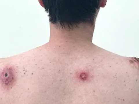 Vết loét tự lành: Dấu hiệu cảnh báo bệnh giang mai?