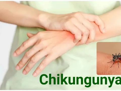 Bộ Y tế bác thông tin Việt Nam phát hiện ca mắc Chikungunya