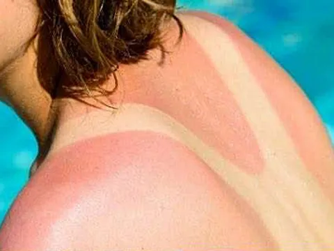 Gia tăng ung thư da vì phơi nắng quá mức