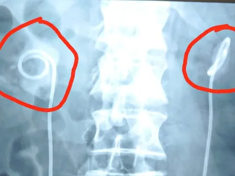 Quên rút ống thông niệu quản suốt 2 năm, người đàn ông biến chứng nặng nề