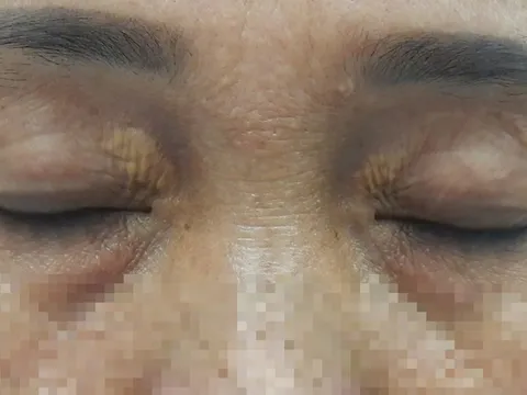 Mí mắt nổi mảng màu vàng, coi chừng rối loạn lipid máu