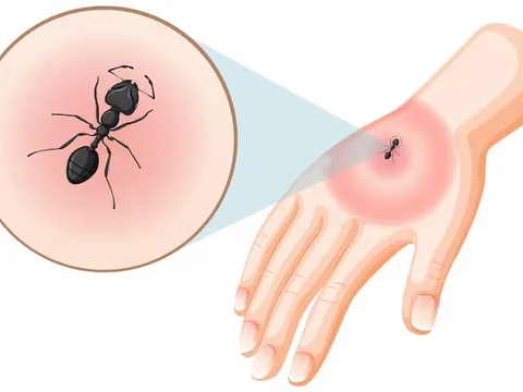 Thực hư chuyện dùng kiến để xua đuổi muỗi truyền bệnh chikungunya