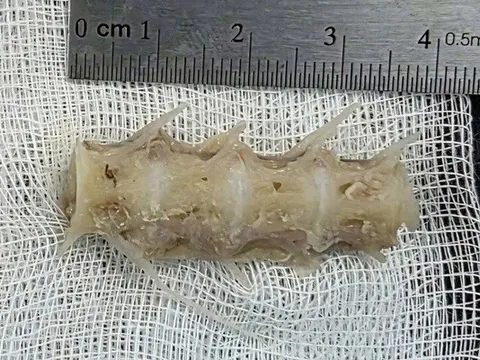 Hóc đoạn xương sống cá 4cm trong cổ, cụ ông 99 tuổi nguy kịch