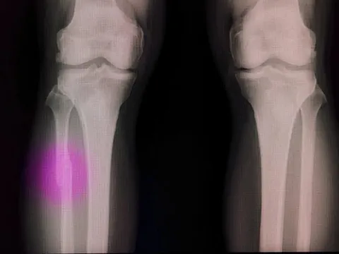 Tạo ra 'súng bắn keo 3D' tái tạo xương ngay trong ca mổ