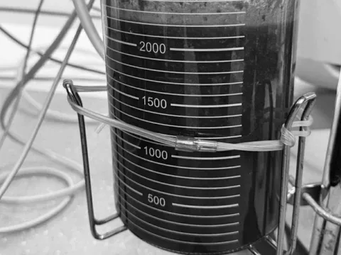 Sau nâng ngực 5 năm, cô gái gặp biến chứng, hút ra hơn 2 lít dịch và silicon