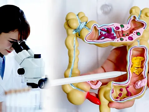 Phương pháp mới phát hiện 90% ca ung thư đại trực tràng không cần nội soi