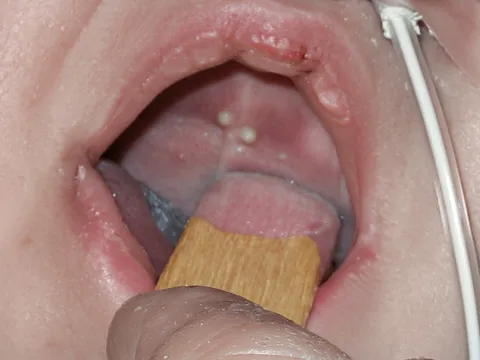 Con bạn có nanh sữa khi vừa sinh, có cần điều trị sớm?