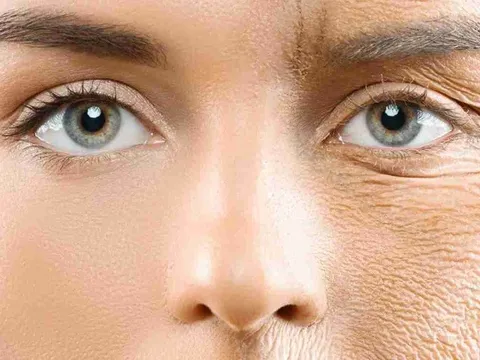 Serum tự làm từ phèn chua và vitamin E giúp xóa nếp nhăn vĩnh viễn?