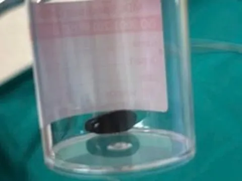 Bé Campuchia bị hóc hạt mãng cầu 20 ngày, được bác sĩ Việt Nam cứu kịp thời