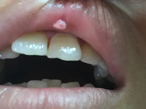 Oral sex tưởng an toàn, cô gái trẻ mắc sùi mào gà ở miệng