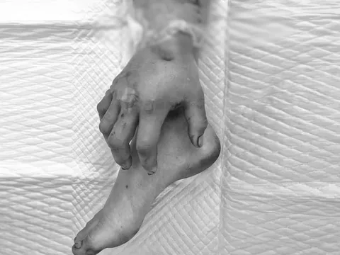 9 giờ ghép bàn tay đứt lìa vào chân cho cô gái mang song thai