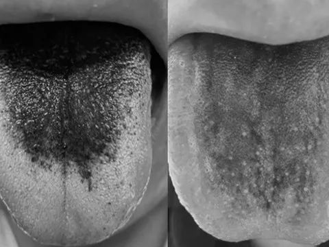 Lưỡi đen bất thường có phải bệnh nguy hiểm?