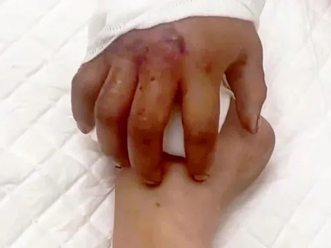 Độc đáo kỹ thuật 'nuôi chi' tái tạo cơ thể