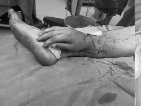 Bàn tay ghép vào chân sản phụ mang song thai đã hồng hào