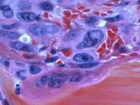 Làm rõ tin đồn 'khối u là túi độc tố và sinh thiết khiến độc tố phát tán'