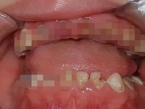 Những ảnh hưởng tới răng, xương hàm, gia đình có trẻ bú bình cần biết