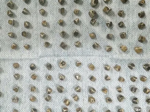 Đau bụng đi khám, người phụ nữ sốc khi bác sĩ lấy ra 130 viên sỏi mật