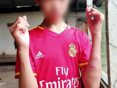 Nam sinh bị nhóm bạn đánh bầm tím trên đường đi học về, trường đang xác minh