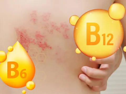 Có thể chăm sóc và hỗ trợ chữa trị người bệnh zona thần kinh bằng thực phẩm?