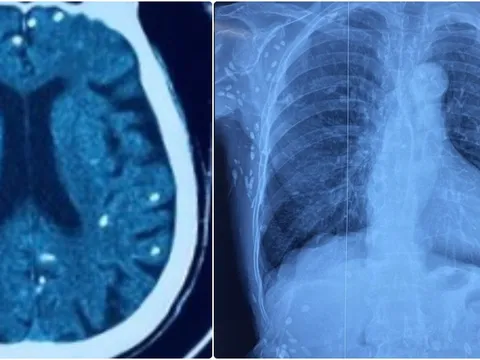 Rùng mình với hình ảnh nang sán dây lợn gây vôi hóa đầy cơ thể