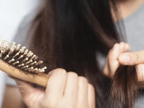 Rụng tóc 'tấn công' người trẻ Hàn Quốc