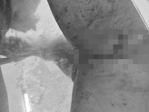 Nối thành công động mạch cánh tay cho bệnh nhân ở Phú Quốc