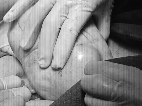 Cắt bỏ khối u nang buồng trứng nặng gần 2kg