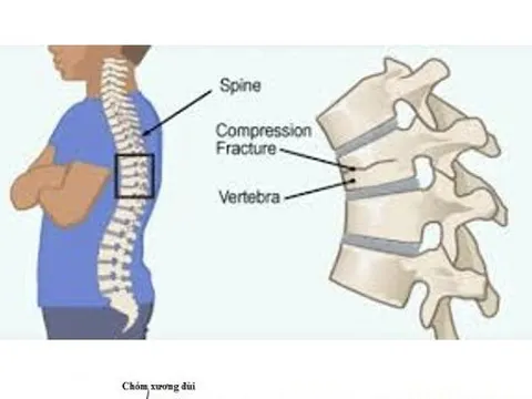 Loãng xương - căn bệnh bị xem nhẹ nhưng tỉ lệ tử vong cao