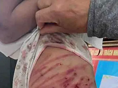 Công an làm việc với người cha dượng liên quan đến bé gái lớp 5 nghi bị bạo hành