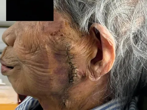 Phẫu thuật cắt bỏ khối ung thư lớn trên mặt cụ bà 99 tuổi