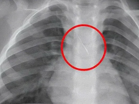 Kim chọc tủy dài 22mm rơi vào đường thở bé trai 3 tuổi khi làm răng