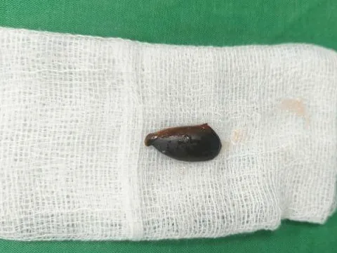 Ho nhiều cả năm, đi khám bất ngờ biết hạt hồng xiêm mắc trong phế quản