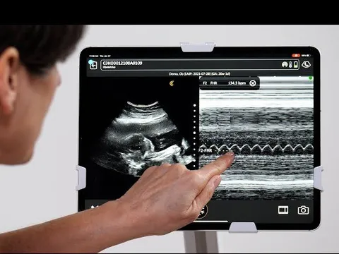 Mẹ bầu nên biết: Siêu âm tim thai giúp bác sĩ chuẩn bị gì cho bé sau sinh?