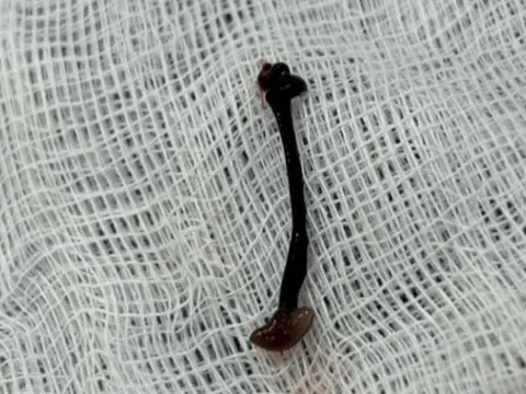 Bé trai chảy máu mũi cả tuần vì con vắt sống ký sinh trong hốc mũi